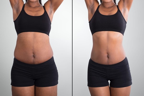 Fat Removal and Body Contouring Surgery