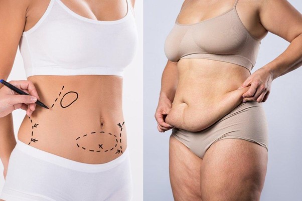Liposuction and Tummy Tuck Surgery in Singapore